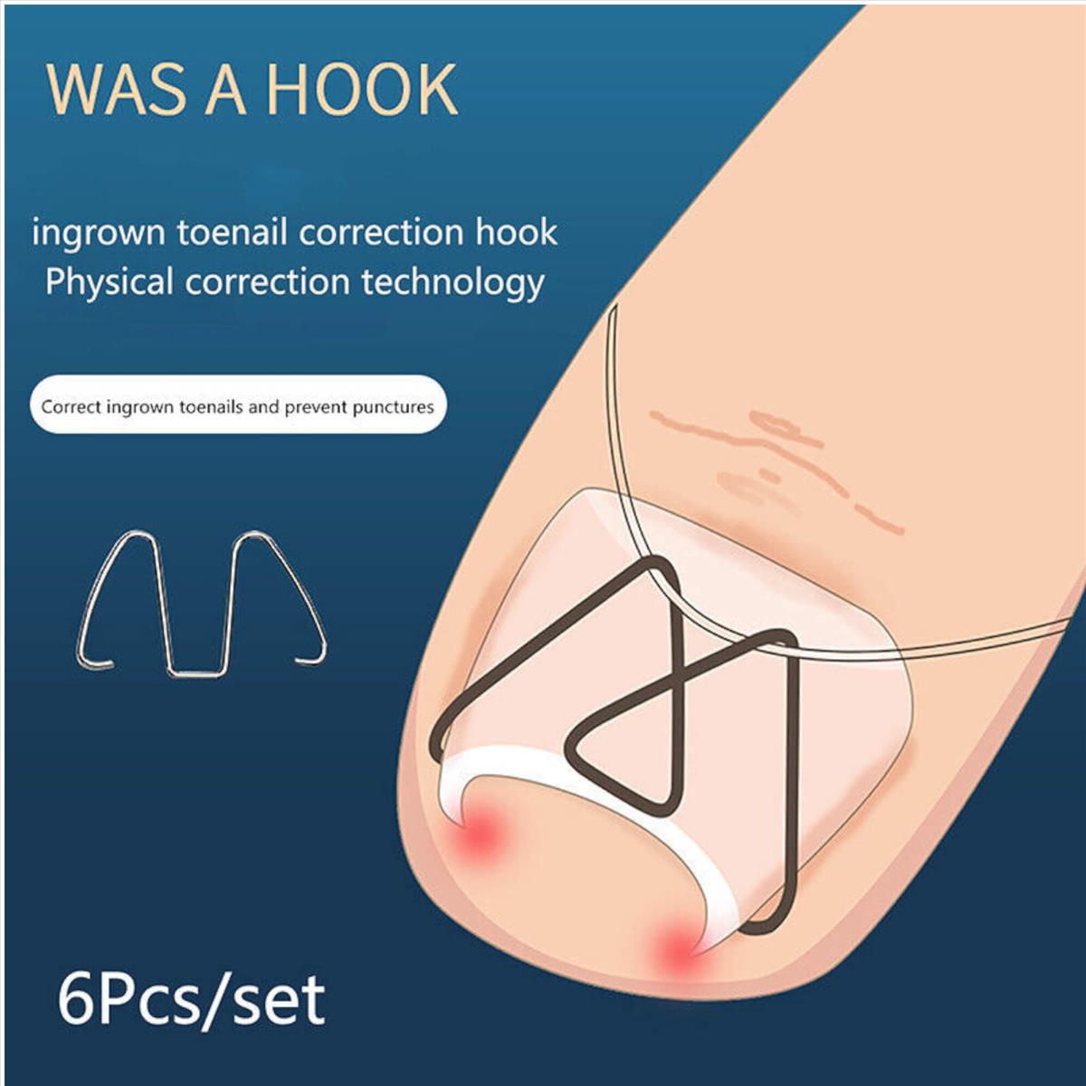 Νάρθικας Νυχιών Ingrown toenail Mr. Jiang 6pcs