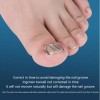 Νάρθικας Νυχιών Ingrown toenail Mr. Jiang 6pcs