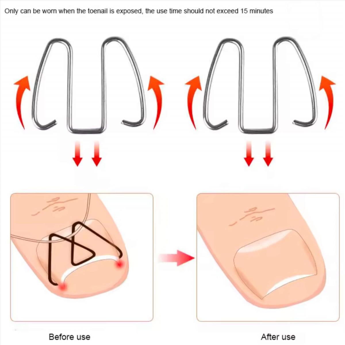 Νάρθικας Νυχιών Ingrown toenail Mr. Jiang 6pcs