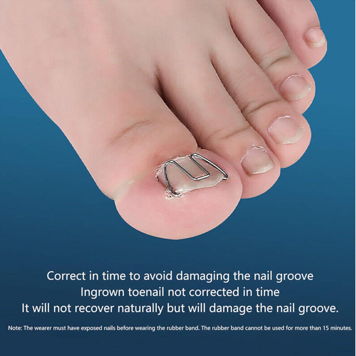 Nail Splint Ingrown toenail Mr. Jiang 6pcs