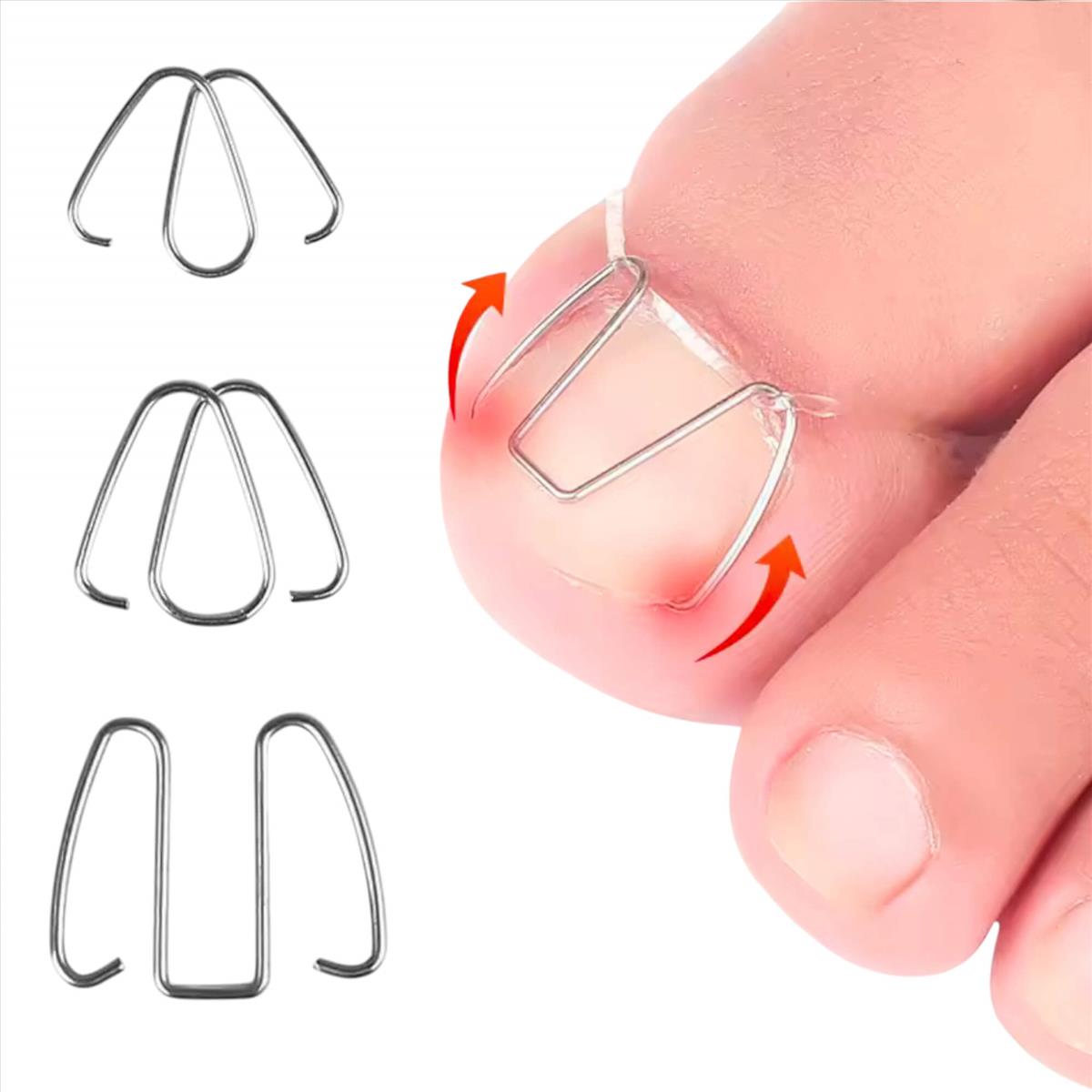 Nail Splint Ingrown toenail Mr. Jiang 6pcs