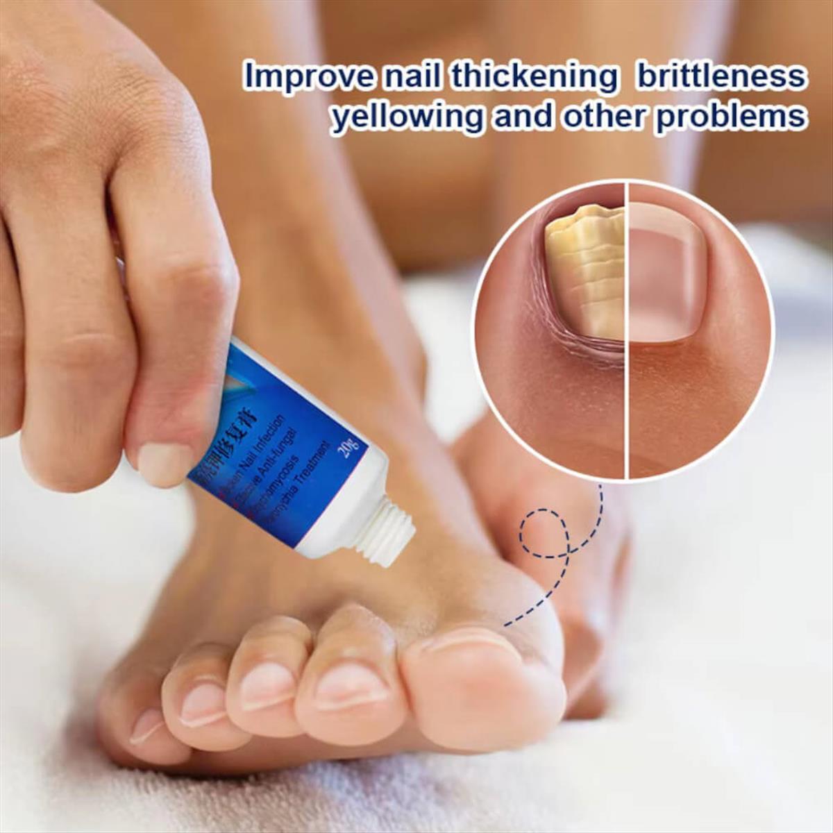 Κρέμα για μύκητες νυχιών Sumifun Nail Fungus 20g