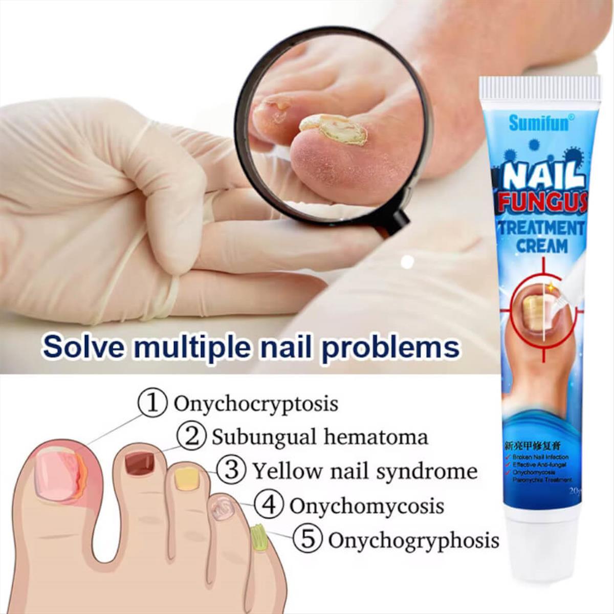Κρέμα για μύκητες νυχιών Sumifun Nail Fungus 20g