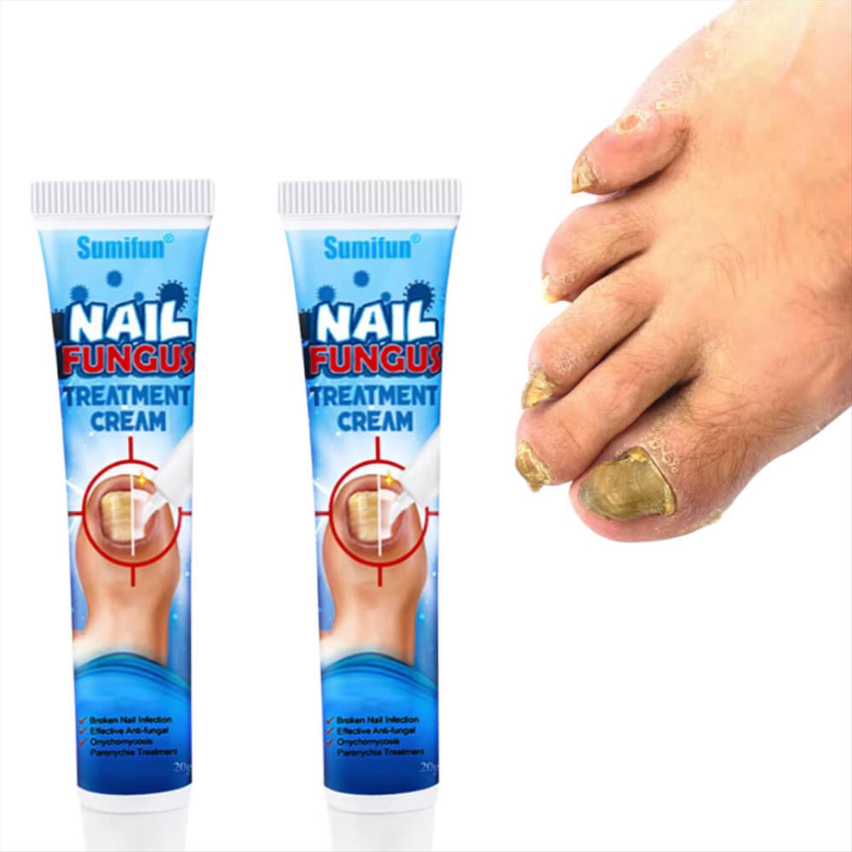 Κρέμα για μύκητες νυχιών Sumifun Nail Fungus 20g