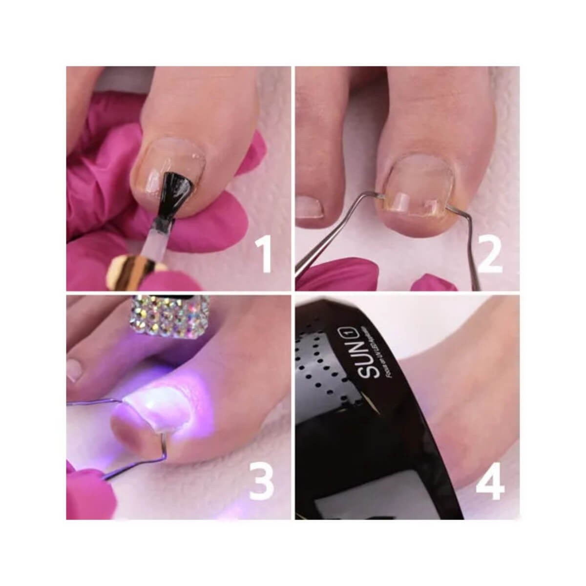 Θεραπεία αντιμετώπισης εισφρύσεων Orθonyx 15ml Laloo