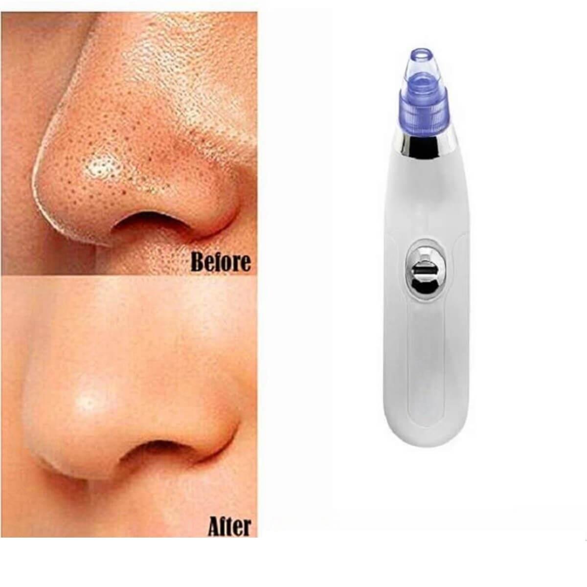 DermaSuction Συσκευή Καθαρισμού Προσώπου & Σμήγματος