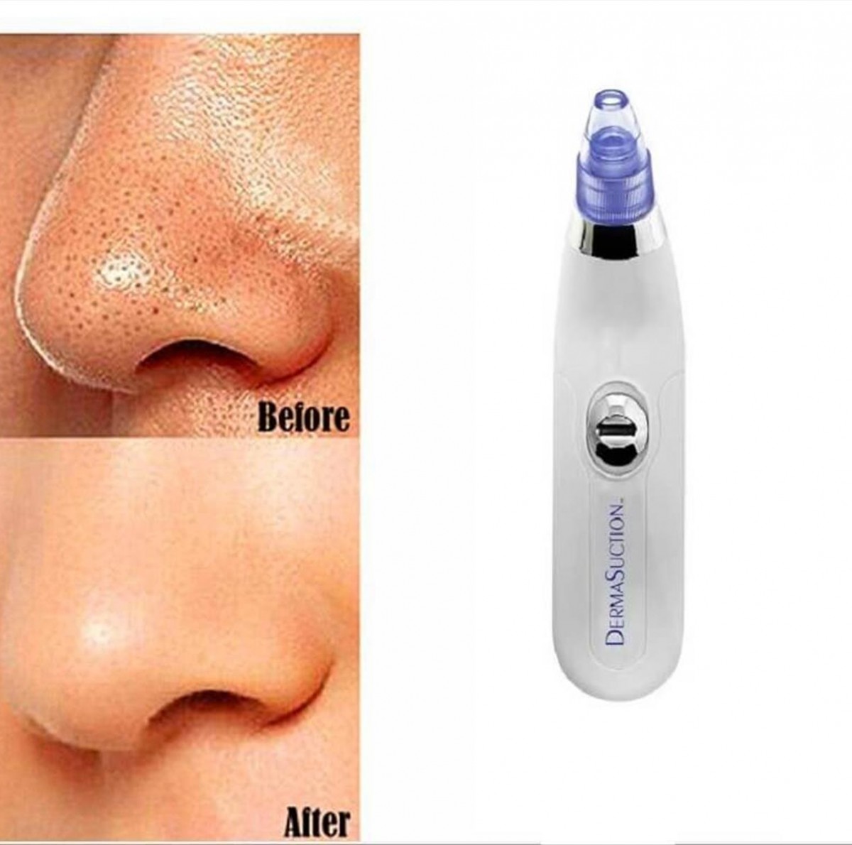 DermaSuction Facial & Sebum Cleansing Device