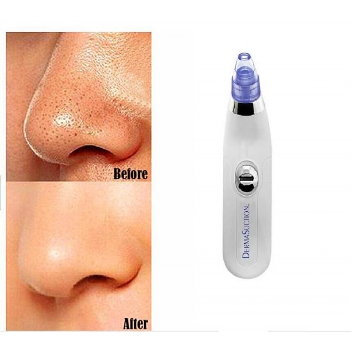 DermaSuction Facial & Sebum Cleansing Device