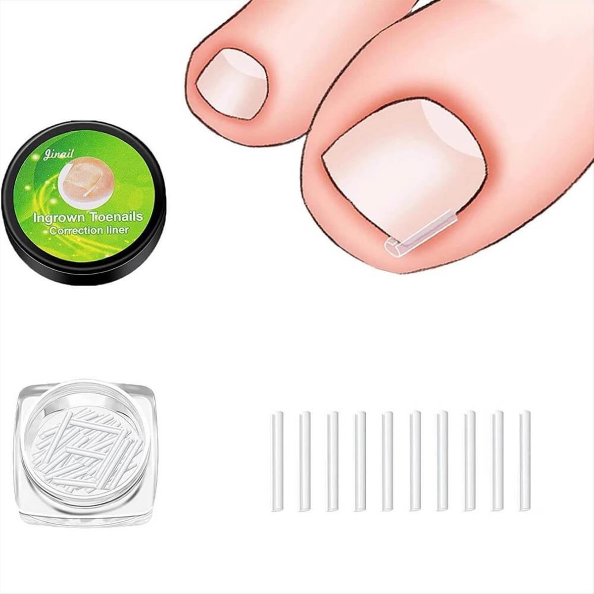 Ingrown Toenail Correction Liner